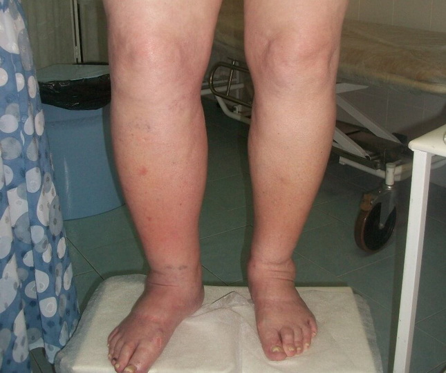Отеки ног при варикозе, эффективное лечение в домашних условиях