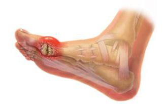 Причины и лечение отложения солей в суставах ног