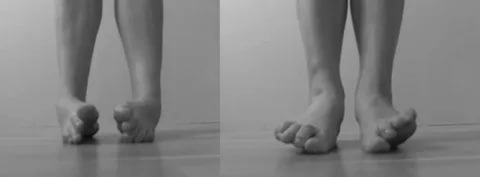 Исправление кривых ног без операции