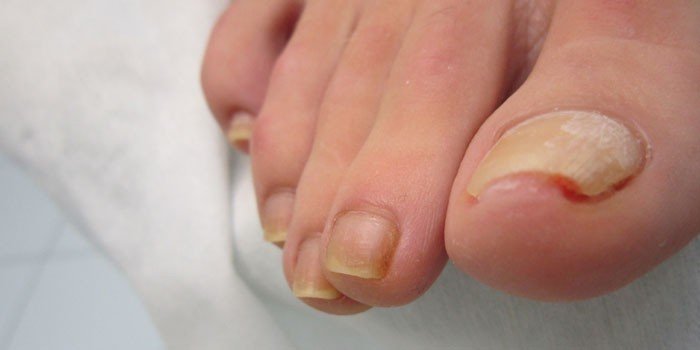 Лазерное удаление вросшего ногтя на большом пальце ноги
