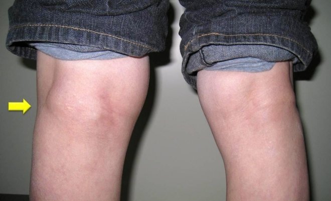 Специфика и виды операций по удалению кисты Бейкера коленного сустава