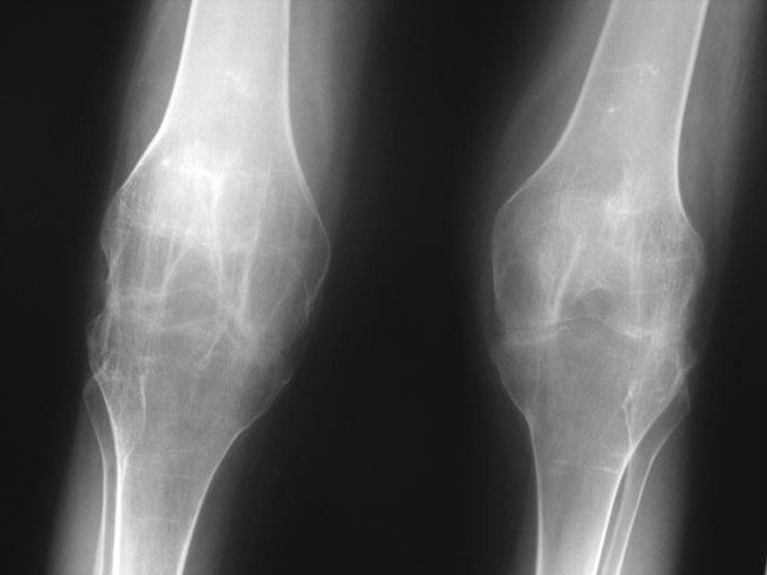 Анкилоз коленного, голеностопного и тазобедренного сустава