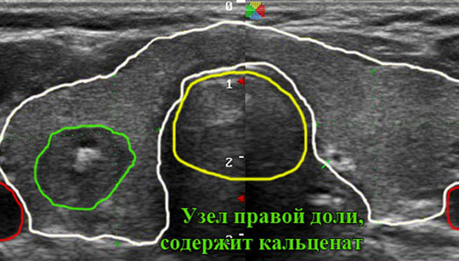 УЗИ щитовидной железы: визуализация кальценатов