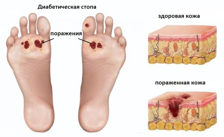 Мази и кремы для ног при сахарном диабете