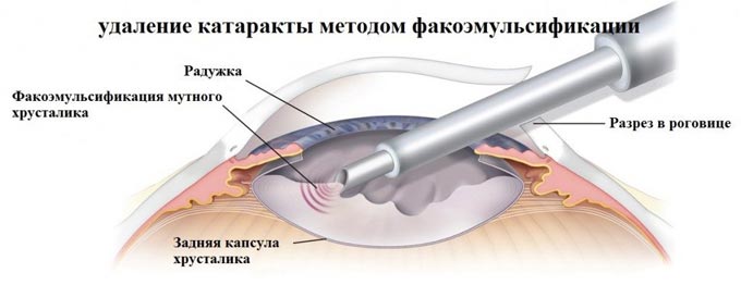 ультразвуковая факоэмульсификация катаракты