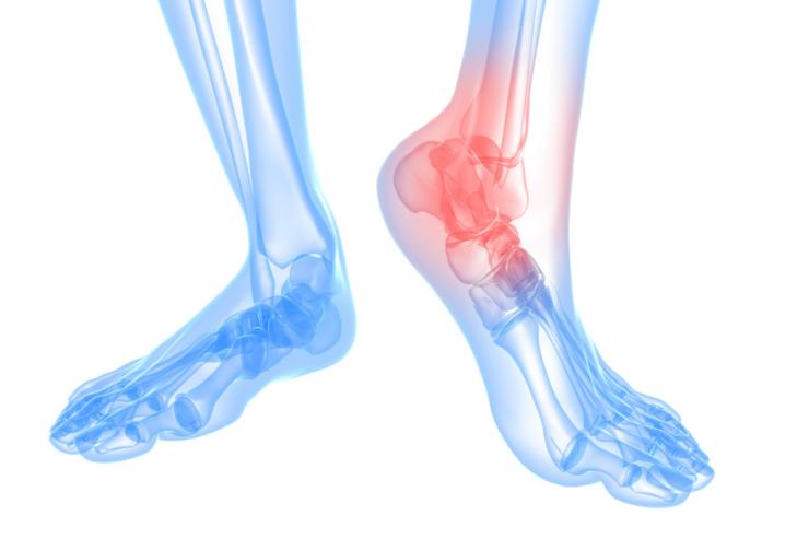 Анкилоз коленного, голеностопного и тазобедренного сустава