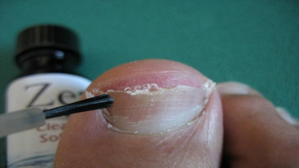 Обзор действенных лаков от грибка ногтей на ногах