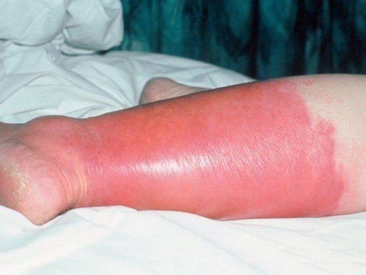 Эритематозная рожа ног: код по МКБ-10, симптомы, лечение