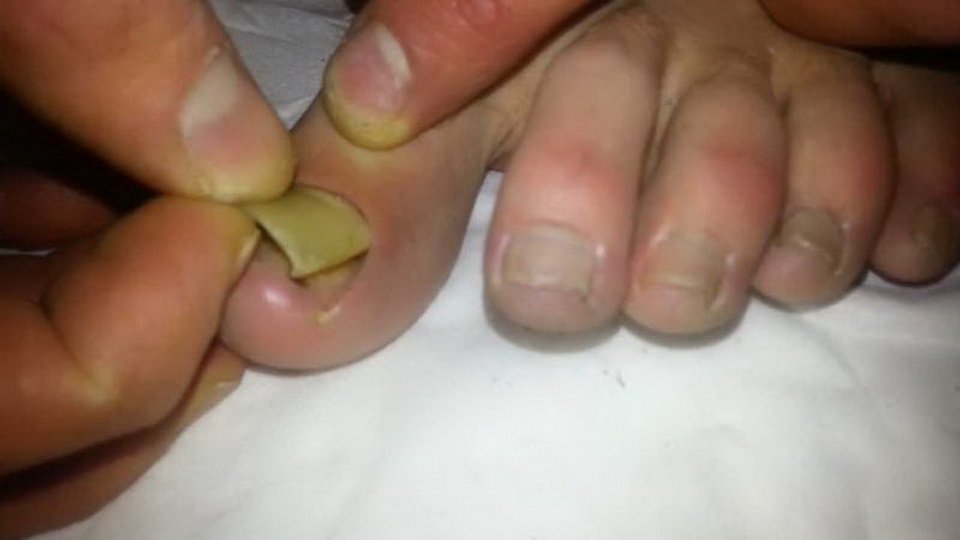 Схема терапии грибка ногтей на ногах