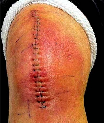 Осложнение после операции на колено