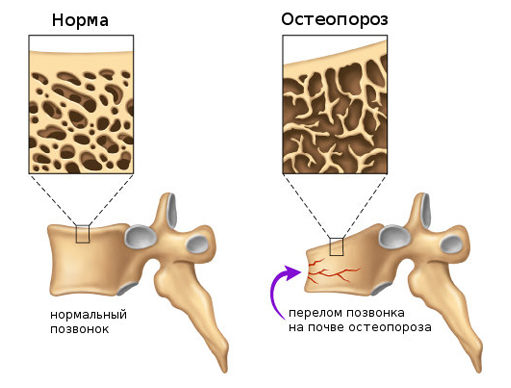 Остеопороз позвоночника