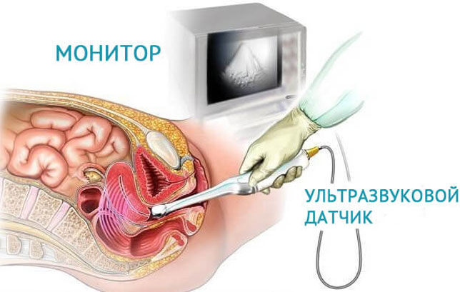 Порядок проведения ультразвукового исследования через влагалище