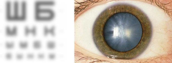 профилактика катаракты