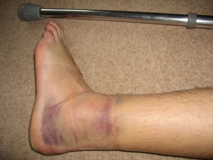 Признаки и лечение перелома ноги