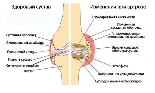 Артроз коленного сустава