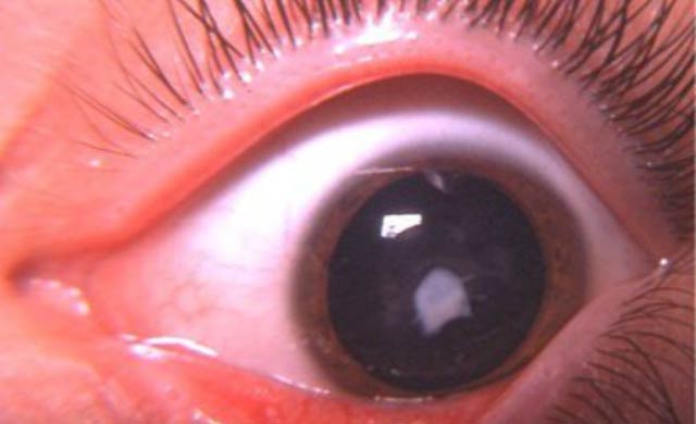 врожденная катаракта у детей
