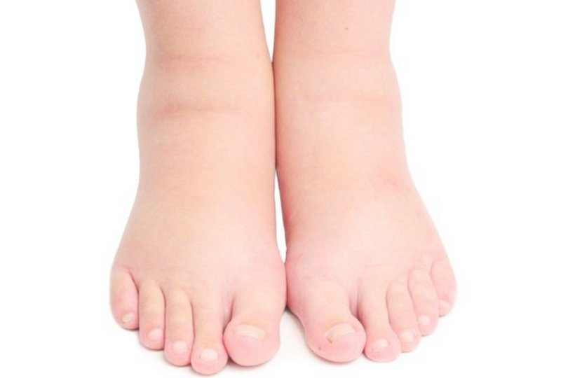 Причины отеков ног в области щиколоток