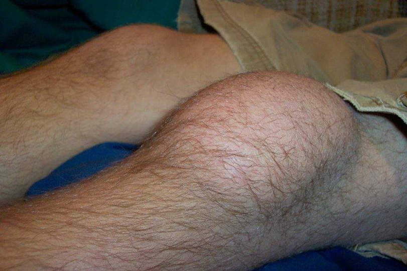 Можно ли вылечить разрыв связок колена в домашних условиях?