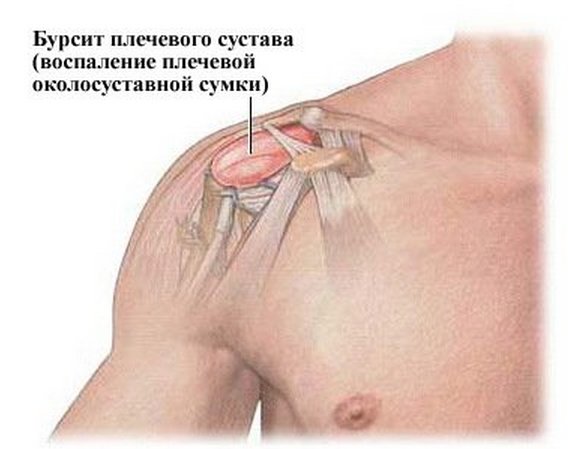 Бурсит плечевого сустава