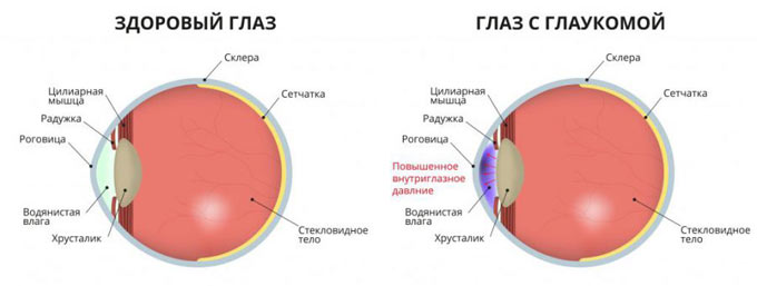 схема глаза с глаукомой