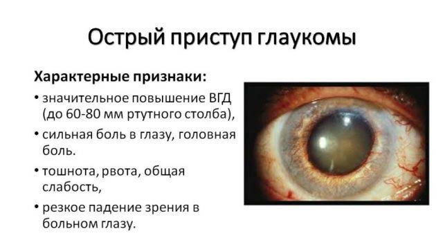 острый приступ глаукомы