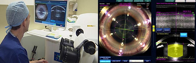 лазерное лечение катаракты