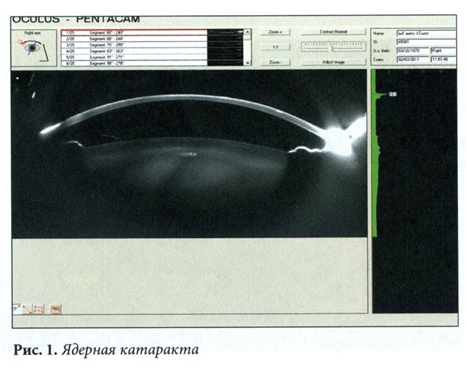 диагностика ядерной катаракты