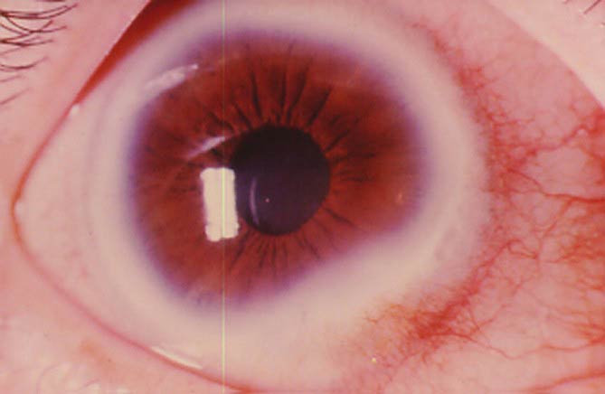 как выглядит патология роговицы глаза