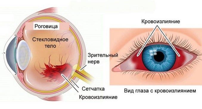 глаз с кровоизлиянием