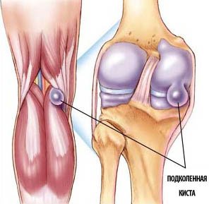 Симптомы и методы лечения кисты Бейкера коленного сустава