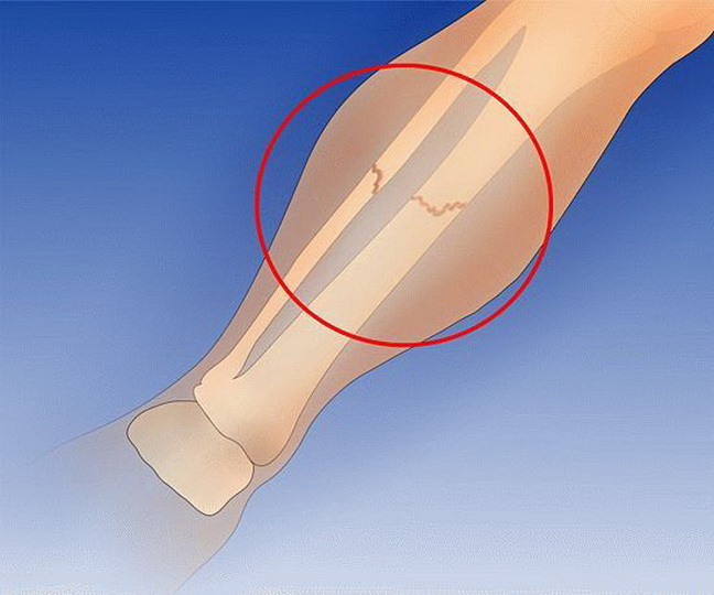 Симптомы и методы лечения трещины в костях ног