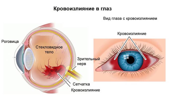 как убрать кровоизлияние в глазу