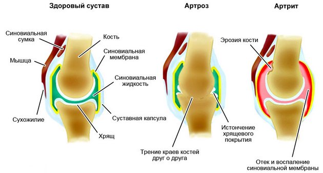Артроз и артрит суставов