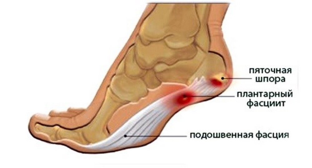 Причины боли ступней под большим пальцем ноги, лечение подошвы