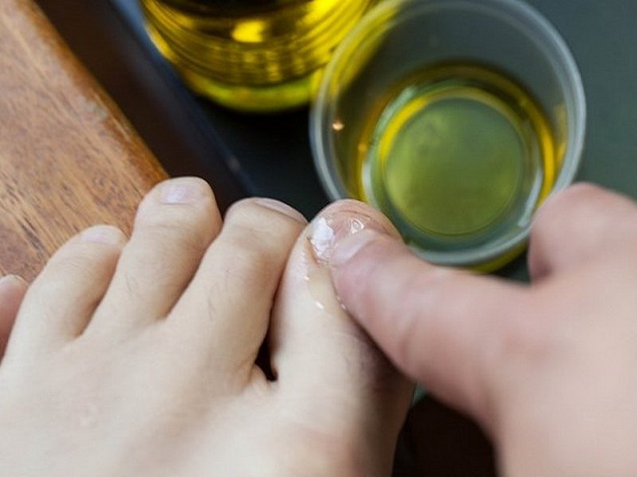 Как использовать масло чайного дерева от грибка ногтей на ногах?