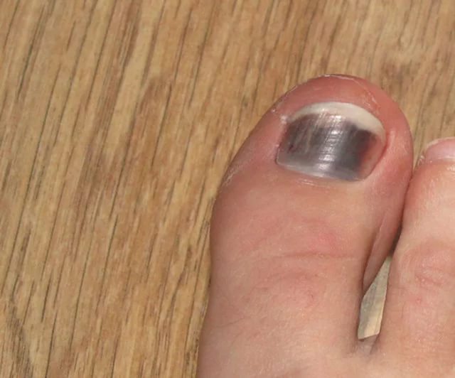 Как лечить синяки под ногтями больших пальцев ног?