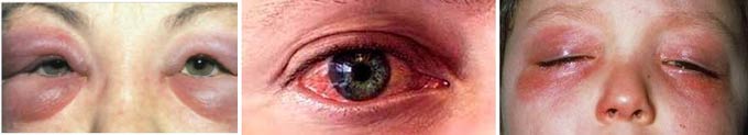воспаление глаз