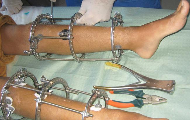 Применение аппарата Илизарова при переломе костей ног