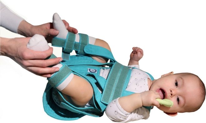 Антеторсия и антеверсия тазобедренных суставов у ребенка