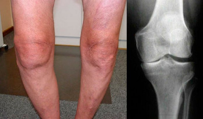 Увеличение колена при гонартрозе