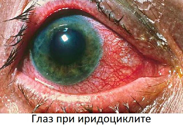 иридоциклит глаза