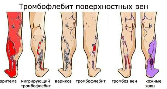 Виды и лечение заболеваний сосудов ног