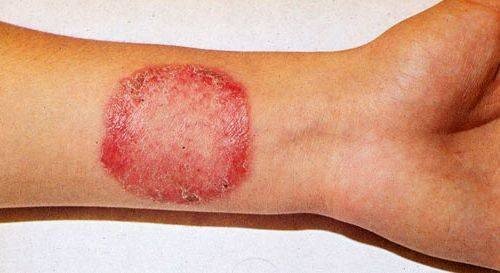 Как выглядит и чем лечится грибок кожи ног?