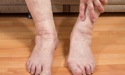 Причины и лечение отечности ног у мужчин