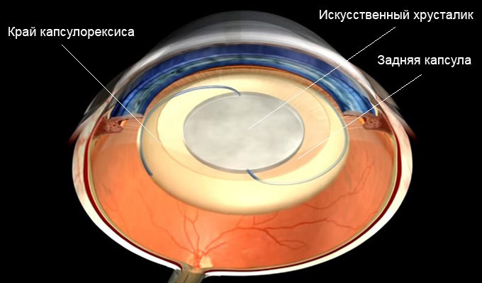 удаление катаракты с заменой хрусталика