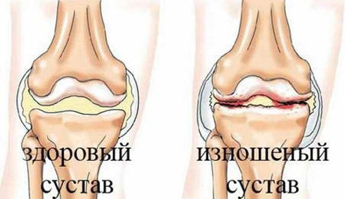 Причины болей в коленях и локтях