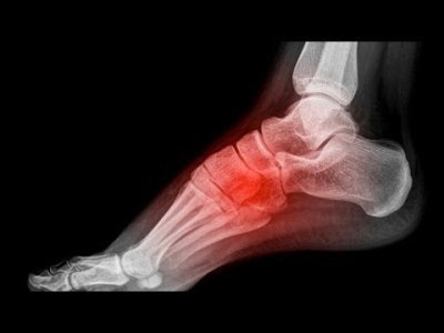 Виды, причины и способы лечения переломов ладьевидной кости