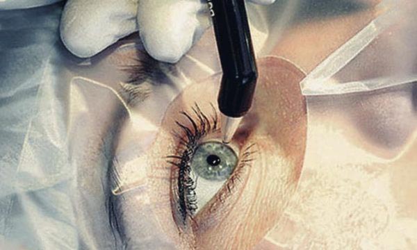 фемтолазерная хирургия катаракты
