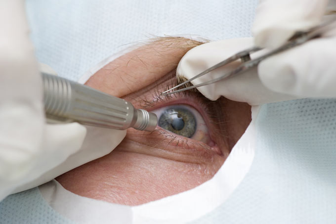 операция по удалению незрелой катаракты