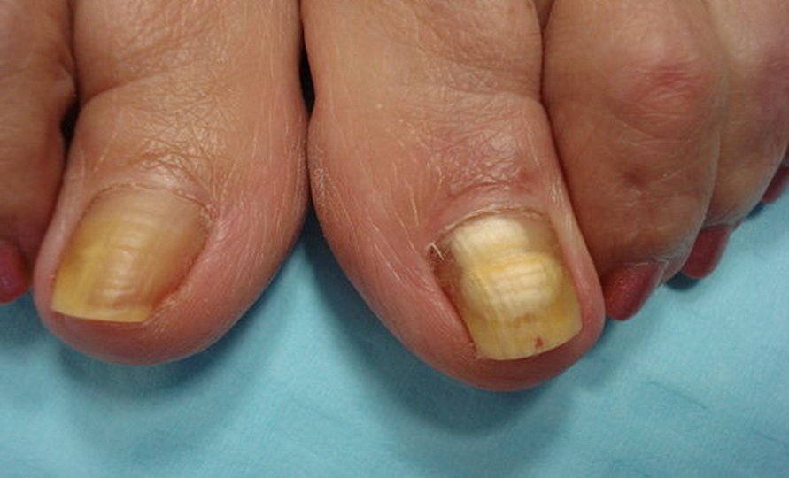 Применение нашатырного спирта при лечении грибка ногтей